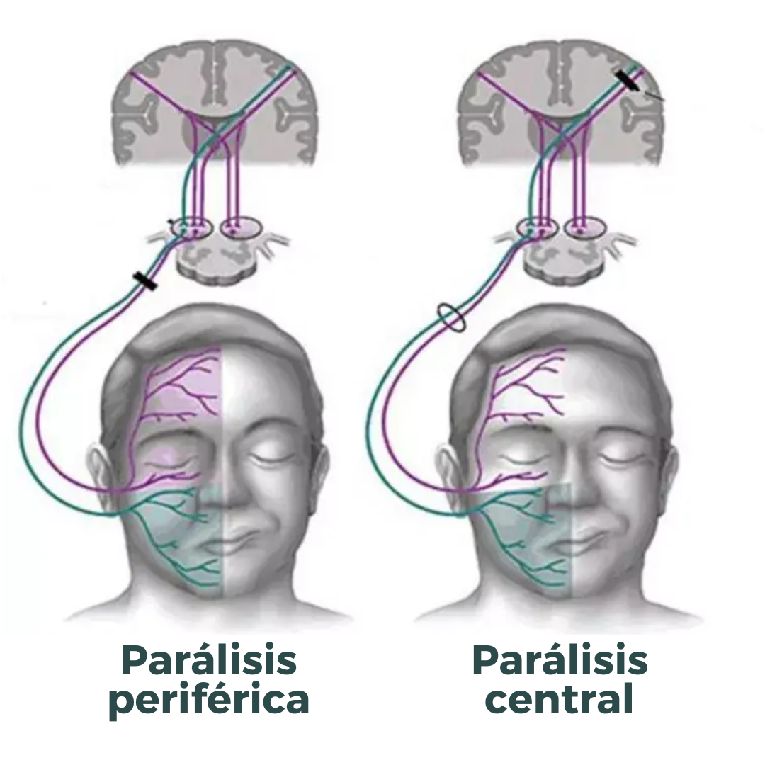 Tipos de parálisis facial Palma Tipos de parálisis facial Palma
