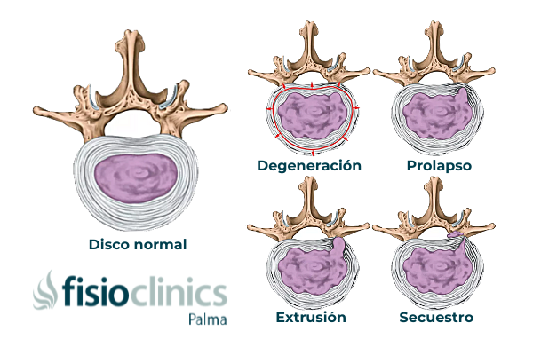 Hernia discal lumbar. Síntomas y causas - Tratamiento en FisioClinics Palma
