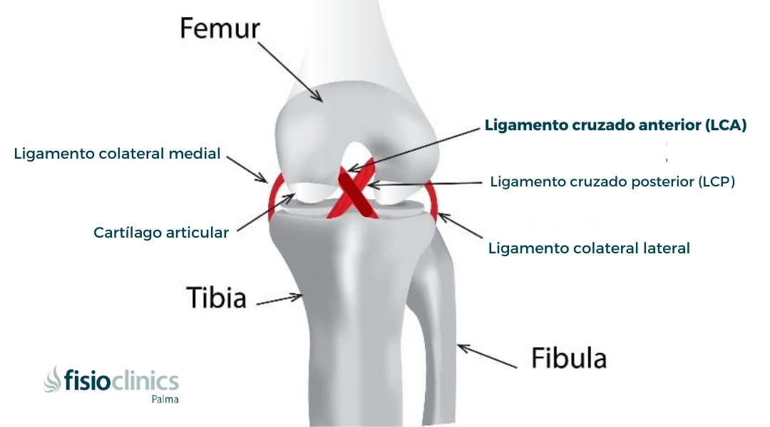 Readaptación deportiva del LCA – FisioClinics Palma | FisioClinics Palma