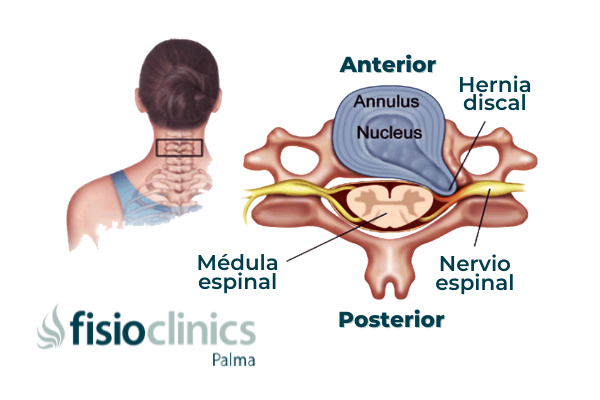 anatomia_hernia_discal_cervical_palma