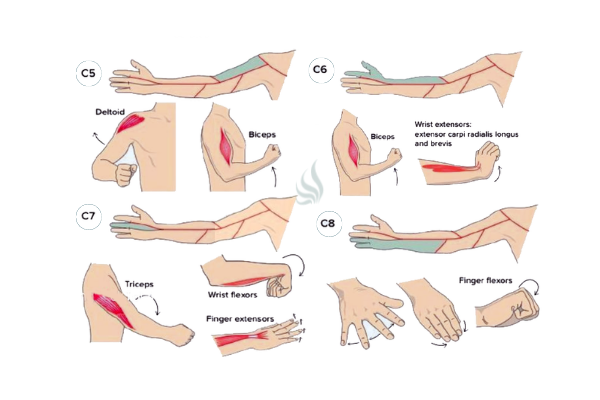Patrones de los síntomas de la Hernia discal cevical palma