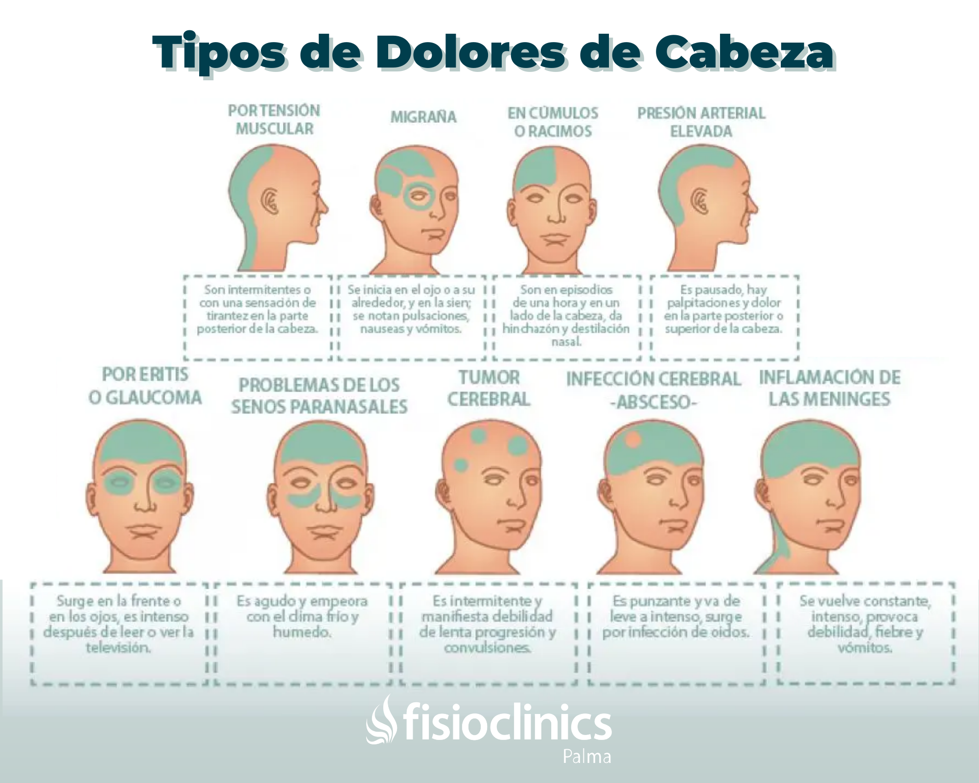 Tipos de Dolores de Cabeza - Palma de Mallorca Tipos de Dolores de Cabeza Palma de Mallorca